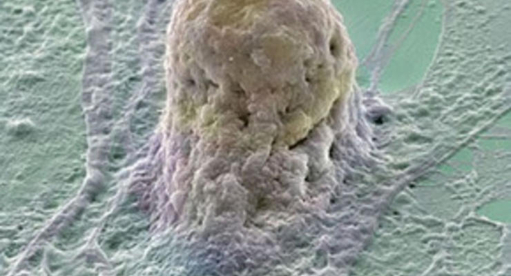 Лечение стволовыми клетками привело к появлению опухолей у подростка