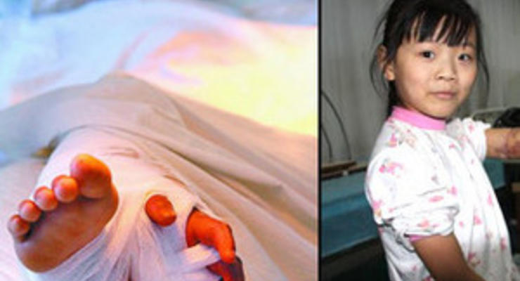 Китайские хирурги сохранили девочке оторванную руку, пришив ее к ноге