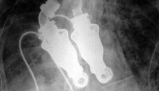 Уникальная операция: Американцу пересадили сердце, которое не бьется