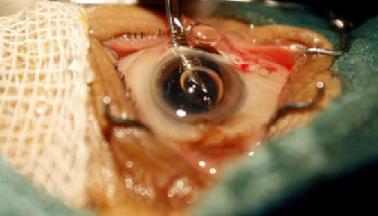 Суд рассмотрит дела против врачей, изымавших роговицу глаз у умерших