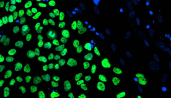 Ученые: Вирус папилломы вызывает рак чаще, чем курение или алкоголь