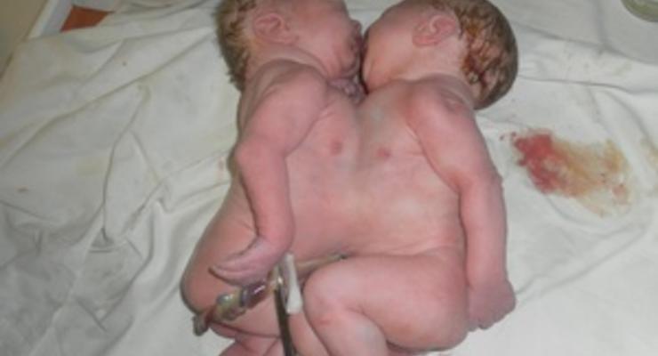 Сиамские близнецы из Краматорска прожили пять дней