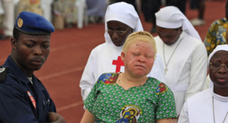В Африке участились случаи нападений на альбиносов