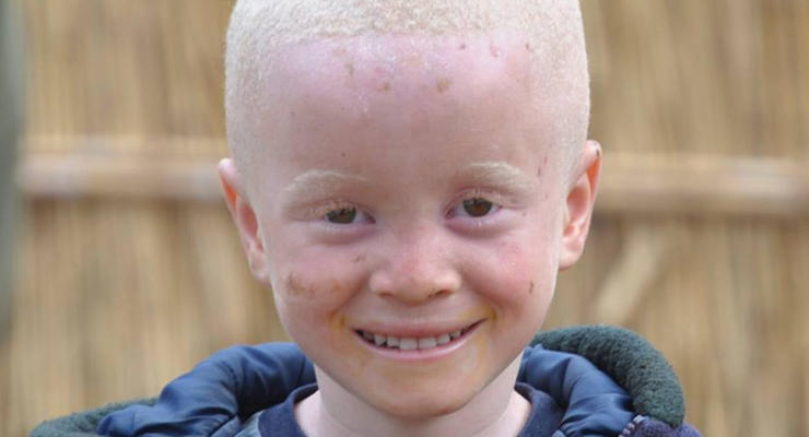 ООН призывает прекратить преступления против альбиносов