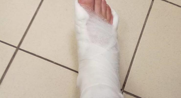Киевлянин сломал ногу из-за разбитого тротуара - соцсети