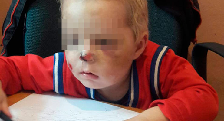 В Житомирской области мать сломала нос двухлетнему сыну