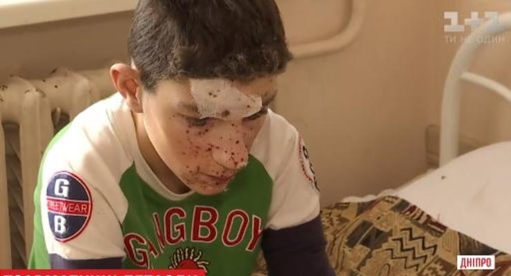 В Никополе детям посекло лицо взрывом петарды