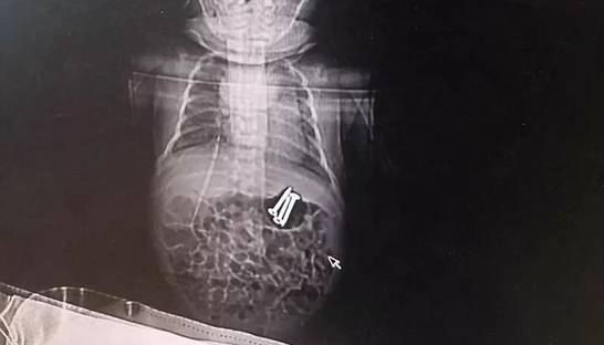 Трехлетний китаец накормил новорожденного брата шурупами