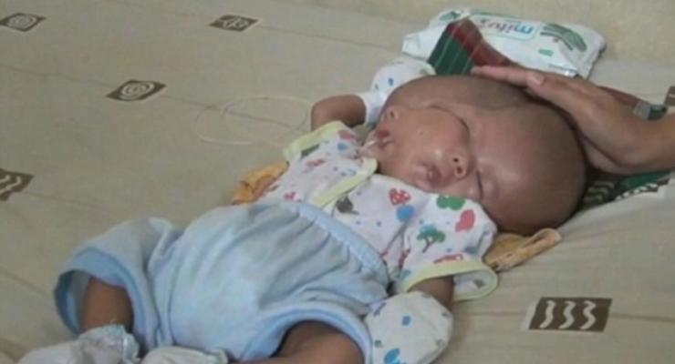 В Индонезии родился двуликий ребенок с двумя мозгами