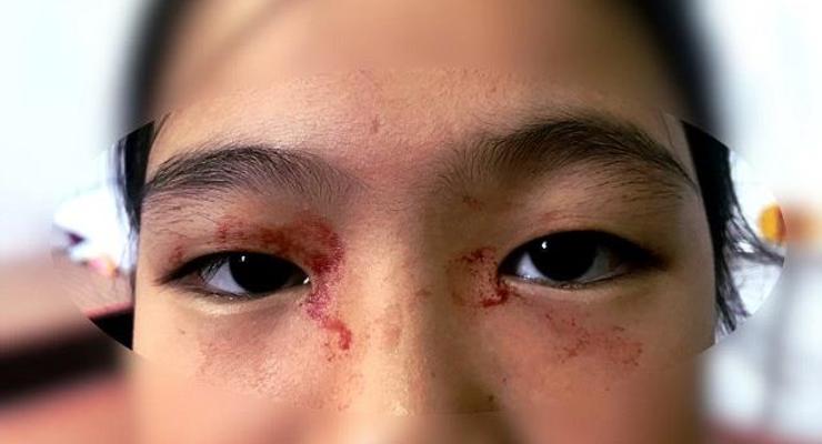 Во Вьетнаме школьница покрылась кровавым потом