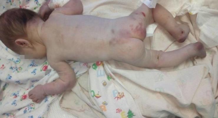 Жестоко избитого младенца подбросили под больницу в Первомайске