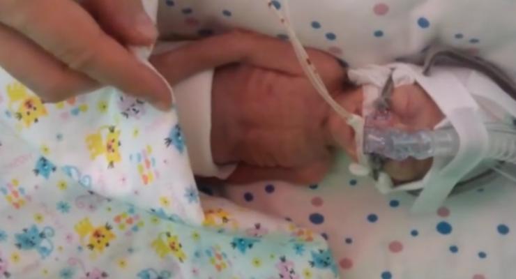 В Днепре зарегистрировали рекорд с самым крохотным новорожденным