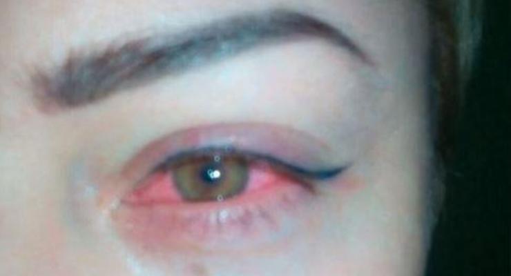 Украинка почти ослепла на один глаз после косметической процедуры
