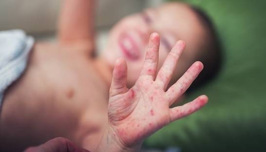 От кори в Украине с начала года умерли 12 человек