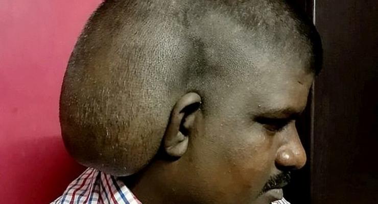 В Индии мужчине удалили огромную опухоль на голове