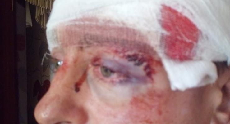 Под Житомиром молотком избили депутата: фото 18+