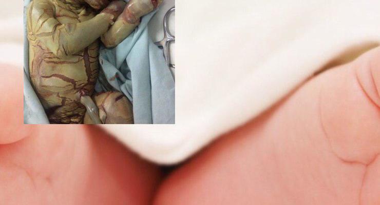 В Италии малыша с “синдромом вампира” оставили в больнице