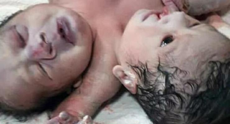 В Индии родился двухголовый и трехрукий ребенок