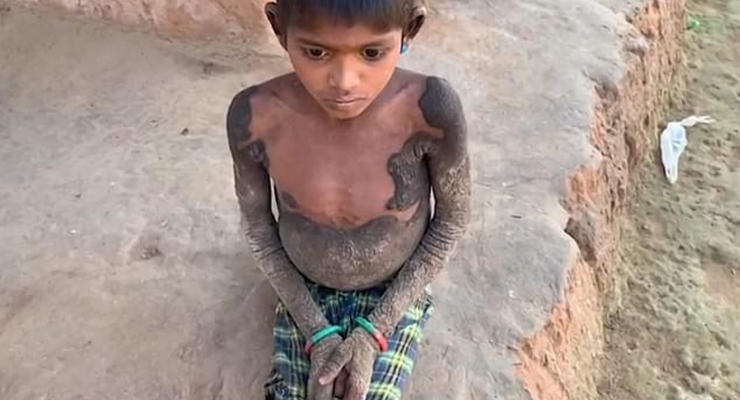 В Индии ребенок "окаменел" из-за редкой болезни