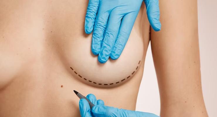 Подтяжка груди как альтернатива имплантам, показания и противопоказания для операции